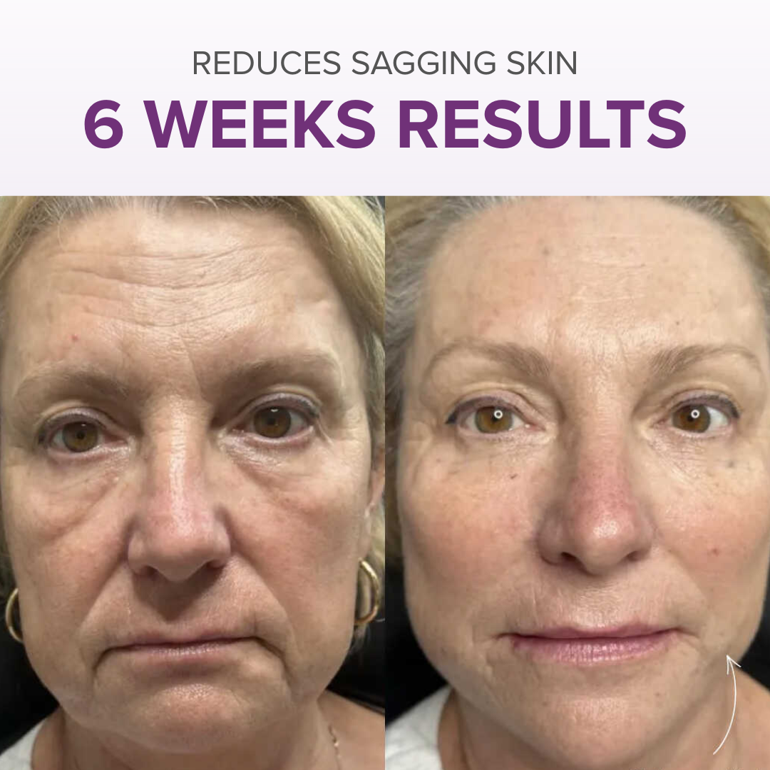 VitalRoll Sculptor + Free Serum