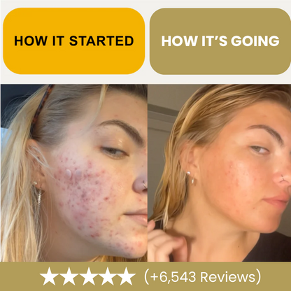 Kill Acne & Redness Ritual